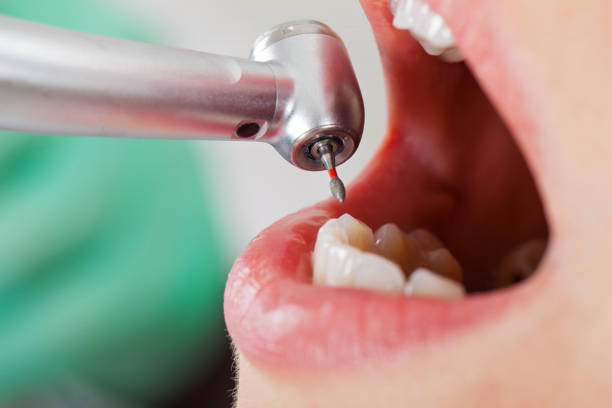 Best Broken or Cracked Tooth Emergency Dentist in Kearney, MO